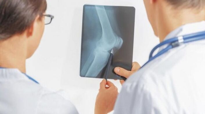 Po niezbędnej diagnozie artrozy stawu kolanowego lekarze przepisują kompleksowe leczenie
