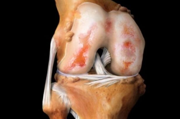 Zniszczenie stawu kolanowego z powodu artrozy - powszechna patologia układu mięśniowo-szkieletowego