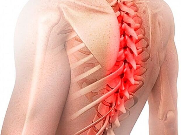 Osteochondroza odcinka piersiowego kręgosłupa jest rzadką postacią choroby