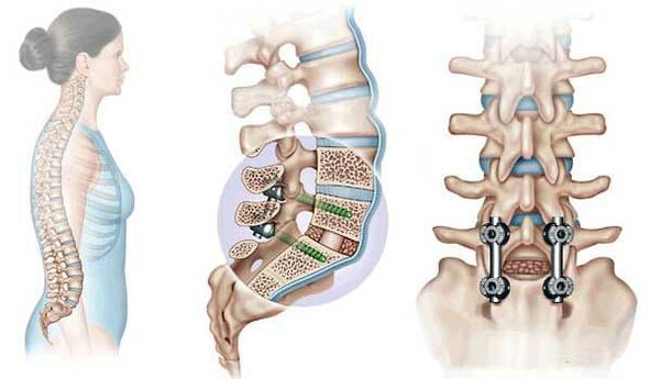 Unieruchomienie przemieszczonych kręgów za pomocą implantów w zaawansowanym stadium osteochondrozy