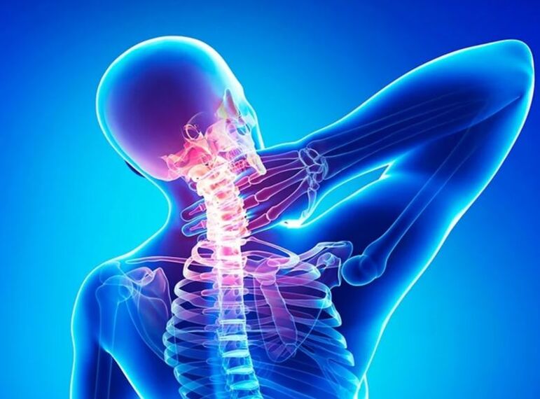 Osteochondroza kręgosłupa szyjnego