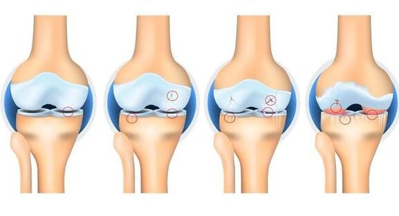 Etapy osteortrozy