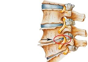 przyczyny osteochondrozy szyjnej