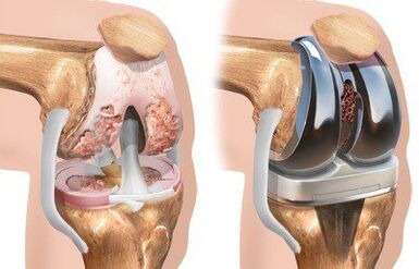 Endoprotetyka stawu kolanowego z gonartrozą